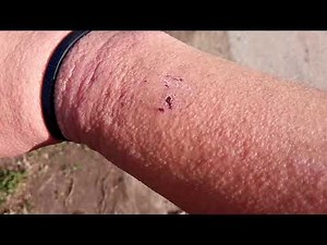 腕が発疹だらけに！ 原因は何なのでしょうか？
