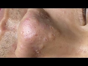 Acne Treament Under The Skin #059