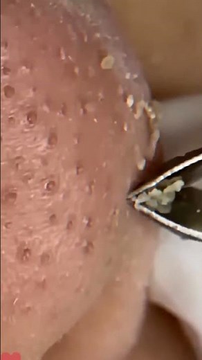 Skincare ｜ Blackheads Removal #tweezer #skincare #blackheads 13