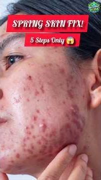 Spring Skin Problems SOLVED! 🚫 Acne, Rash & Oil #foryou #viral #springskincare