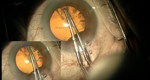 How to Manage a Capsulorrhexis Tear - Eyetube