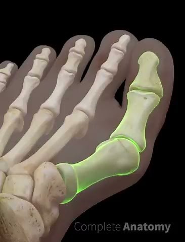 Bunion (Hallux Valgus)