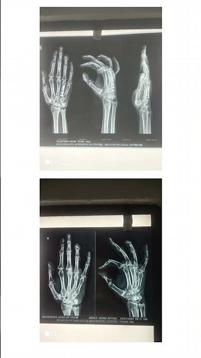 ORIF Surgery for Hand Fracture | Before & After X-Ray Results | Dr. Aditya Pathak