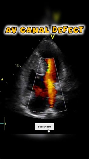AV Canal Defect on Echocardiography