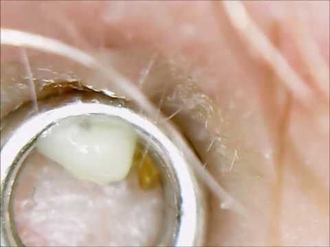 #34 - Fat lip pimple