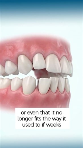🦷 What happens if you stop wearing your retainers after braces?