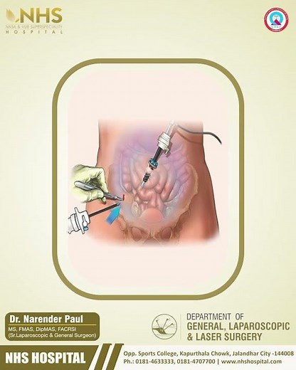 Dr. Narender Explains Laparoscopic Surgery at NHS Hospitals | Fast Recovery for Hernia & Gallstones