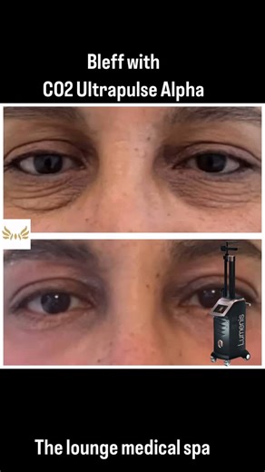 Roula Hamdan | ULTRApulse Alpha is a CO2 ablative laser system used for skin resurfacing, offering a range of treatments for wrinkles, scars, and other... | Instagram