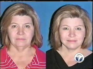 Little Rock SmartLift Face Lift - Cosmetic Surgery Center