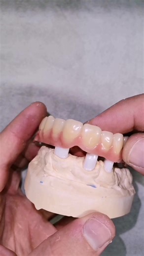 Lower Jaw #zirconia #telescope and PEEK Overdenture Upper Jaw Full Denture . . . . . . . . . #Modellguss #zahntechnik #zahntechniker #dentist #dental #denture #dentista #implants#krone#cercon#dentist#vienna#odonto#dentallabor#dentalpics#dentalwork #vienna #austria #germany #teleskope #زراعه_اسنان #طب_اسنان#تجميل_اسنان #اسنان#تركيبات_أسنان