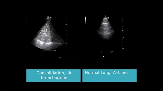 Role of critical care U/S in diagnosing the common causes of fever in the ICU. Register in our recorded online course to learn so many critical care U/S tricks which will change your way of management and boost your ICU skills. We are continuously upgrading our courses., so you will expect new lectures to be added to your course from time to time. Attention please, now the complete arterial Doppler course is added to our recorded critical care U/S from basic to advanced course. Also, this week 1