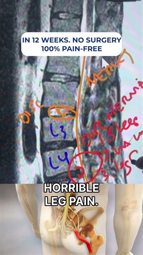 Worsening back or leg pain? Traction may fail—targeted spinal decompression works #sciatica