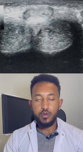 Anterior urethral injury in a 29 year old male after direct kick injury to the perineum. anterior urethral injury can sometimes be visualised with ultrasound with signs such as poor definition of the urethral mucosa, focal hypoechoic thickening of the urethral and adjacent corpus spongiosum small hematoma. #ultrasound #diagnosis #medicaldoctor #radiology #radiologist #ethiopian_tik_tok #ethiopian_tik_tok🇪🇹🇪🇹🇪🇹🇪🇹 #creatorsearchinsights #fyp #habeshatiktok