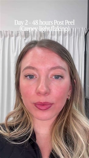 VI Peel Progression #shorts