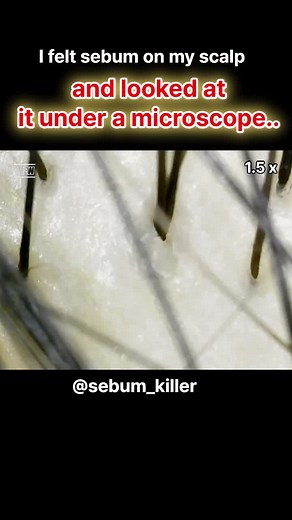scalp sebum removal video #scalp #sebum #sebumremoval #microscope