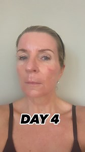 1.8K views · 21 reactions | What is the recovery time for CO2/ erbium...