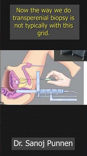 Transperineal Biopsy - Dr. Sanoj Punnen | #activesurveillance #aspi2020