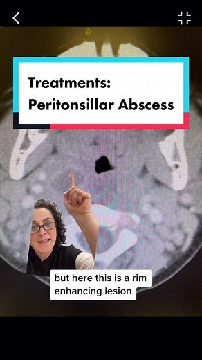 Peritonsillar Abscess Treatment Procedures Explained