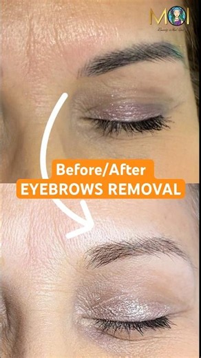 Before and after eyebrows removal !