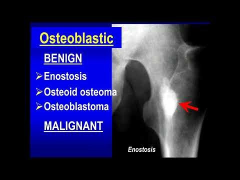 Bone tumour and tumor like lesions