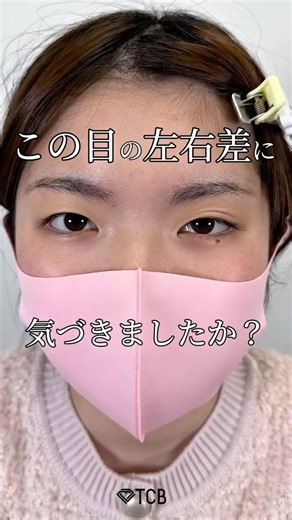 [Double Eyelid Surgery] Did you notice the asymmetry in these eyes? #shorts