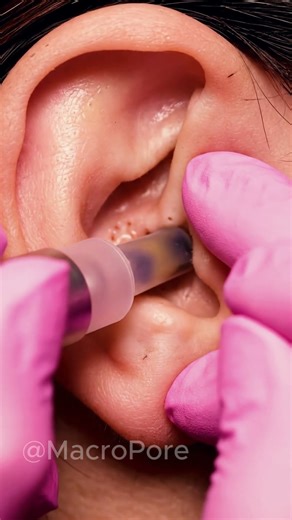 Extreme Ear Blackhead Extraction — So Clean It’s Unreal 🤯 #asmr #vacuum