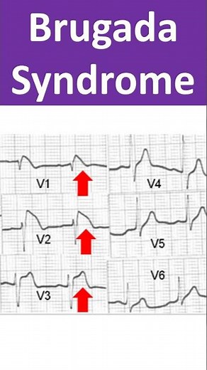 Brugada Syndrome