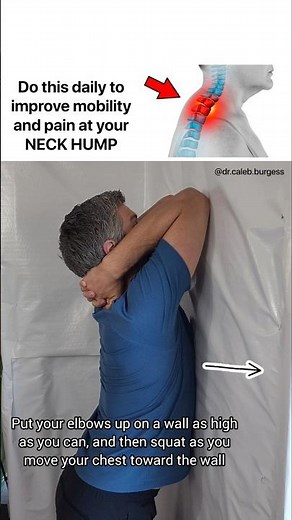 How to Fix your NECK HUMP - Dowager’s Hump