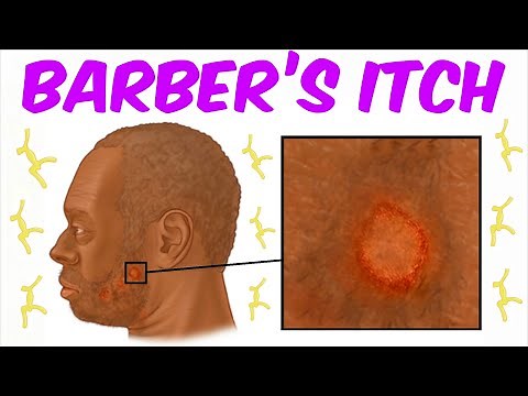 Barber’s Itch EXPOSED: The Shocking Skin Infection From Your Barber’s Razor!