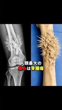 【人類史上最悪の激痛💀】 #雑学 #トリビア #骨腫瘍 #osteosarcoma