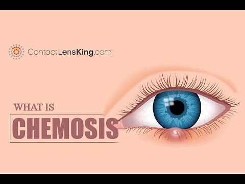 What is Chemosis? Eye Inflammation Causes and Symptoms