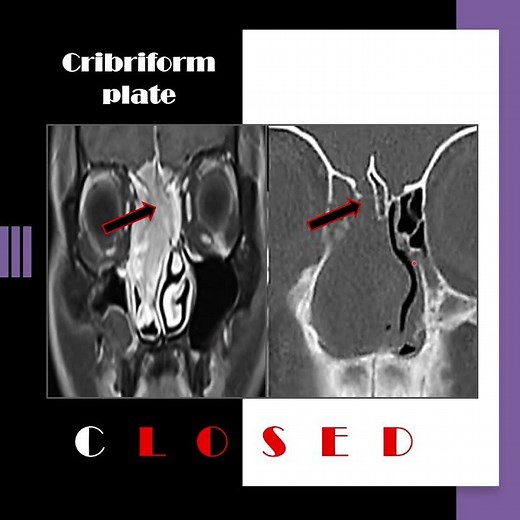 Nose radiology series (4): The cribriform plate (4) #shorts