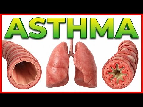 Asthma : Etiology, Pathogenesis, Clinical features, Diagnosis and Treatment