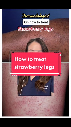 Effective Ways to Treat Strawberry Legs and Keratosis Pilaris