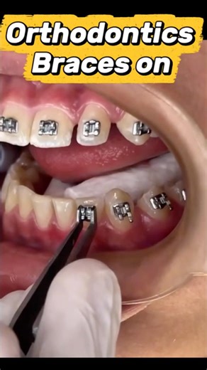Getting Braces On! 🦷✨ #braces #dentist #teeth