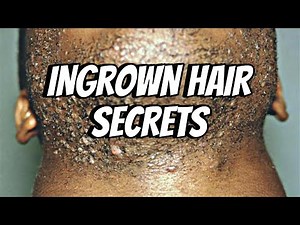 Everything You Need to Know About Ingrown Hairs: Causes, Prevention & Treatment