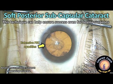 CataractCoach 1242: resident soft posterior sub-capsular PSC cataract
