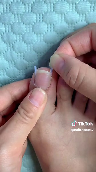 Paronychia corrector and specialized ingrown toenail strips#tiktokgrowthchallenge