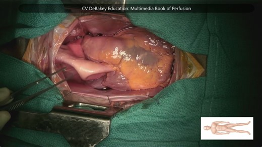 seldinger技术在建立体外循环主动脉插管中的使用