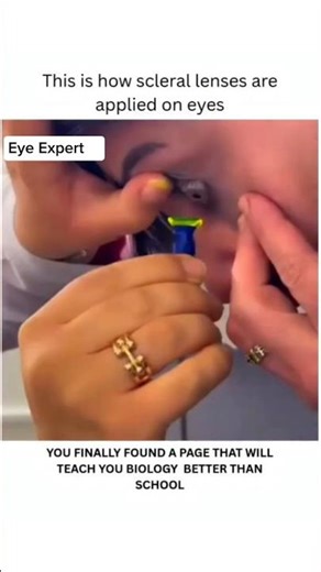 Sclera lens applied for Eyes 👀#eyes #eyespecialist #eyecareprofessional #optometrist