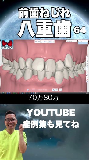 八重歯や出っ歯、前歯ねじれ 口ゴボ ワイヤー矯正安い費用50万円〜鈴木歯科医院 埼玉県さいたま市大宮 矯正歯科医院 マウスピース矯正 茨城県東京千葉からも受付