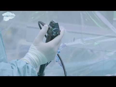 Stone fragmentation using a holmium laser