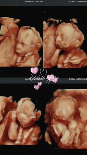 ✨ Experience the future of bonding ✨Book your 5D scan at Dwarka’s first 5D Ultrasound Lab 🤍