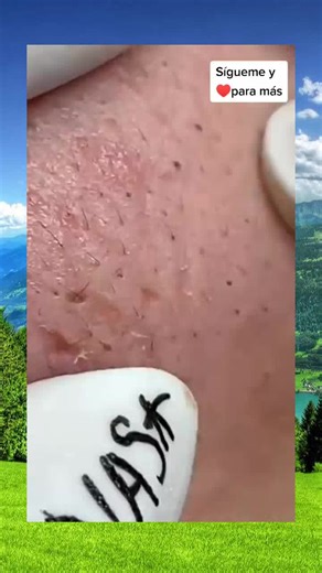 Squeeze Extraction of an Arm Blister Real-Time