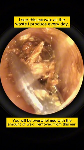 Soothing Ear Cleaning ASMR for Relaxation and Acne Relief