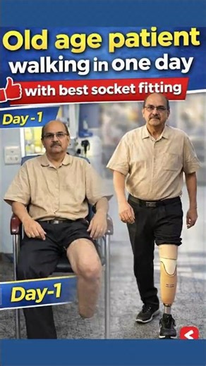 Best Artificial leg Clinic in India | Below knee prosthetic Price #ossur #ampute #naklitang #best