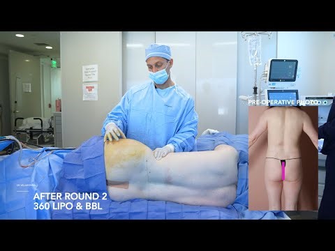 Gender-Affirming Body Contouring | Lipo 360 + BBL Feminization Results – Round 2