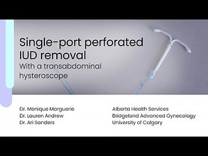 Single-Port Perforated IUD Removal With a Transabdominal Hysteroscope