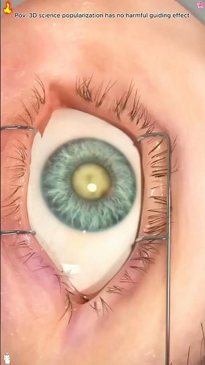 Cataract Surgery (3D Animation) #Cataract #Ophthalmology #Health #MedicalKnowledge