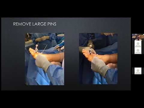 LapiFuse™: Finding a Better Way to Bunion Correction with Dr. W. Hodges Davis